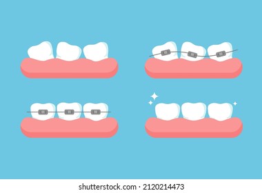 Stages of orthodontic treatment. Teeth without dental braces and after correction. Vector illustration isolated on blue background.