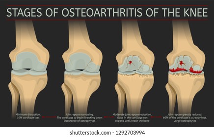 Stages of osteoarthritis of the knee. Editable vector illustration in realistic style isolated on a dark grey background. Medical, healthcare and physiology concept. Scientific infographic.