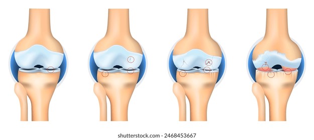 Stages of Osteoarthritis. knee joint anatomy Vector illustration