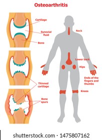 Stages of osteoarthritis and some joints that are commonly affected