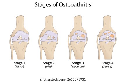 Estágios da ilustração vetorial da osteoartrite	