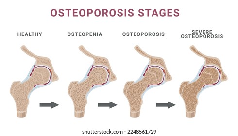 Etapas de la osteoporosis estructura de esponja ósea osteopenia normal y esquema severo de osteoporosis vectorial de ilustración plana. Anatomía humana artritis fractura enfermedad esqueleto quebradizo infografía médica conjunta