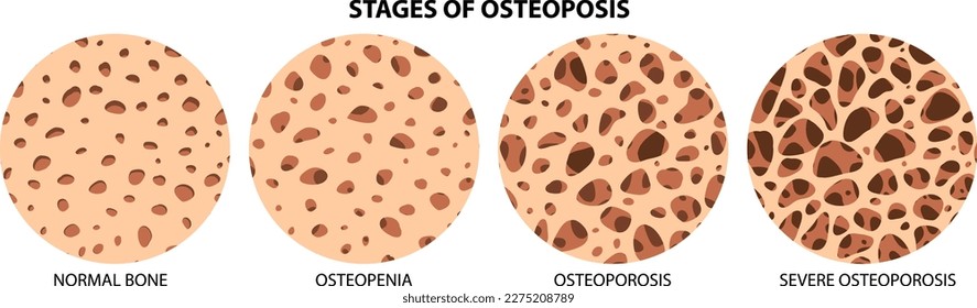 Stages of Osteoposis Vector illustration