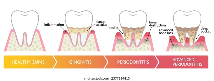 The stages of periodontal disease. dental and oral health care