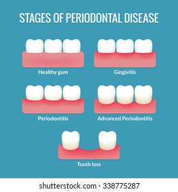 Stages Of Periodontal Disease From Healthy Gums To Gingivitis, Periodontitis And Tooth Loss. Modern Medical Infographic Chart. Vector Illustration.