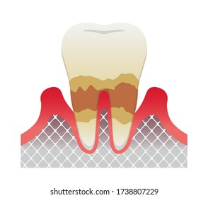 Stages Periodontitis Disease Moderate Periodontitis Stock Vector ...