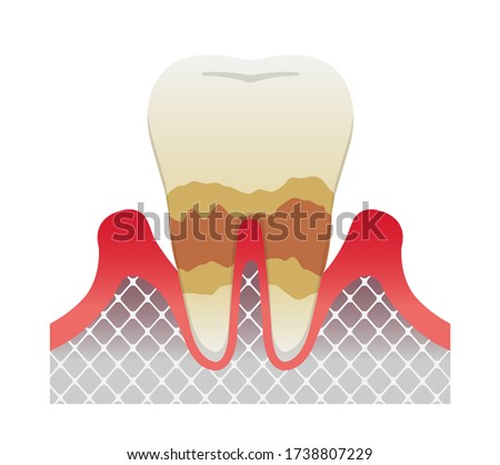 The stages of periodontitis disease / Moderate periodontitis
