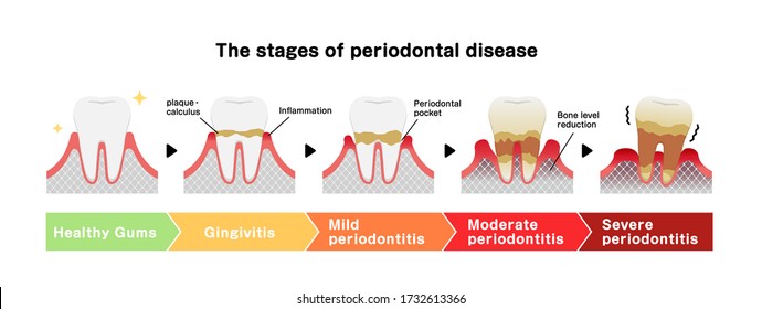 The stages of periodontitis disease vector illustration