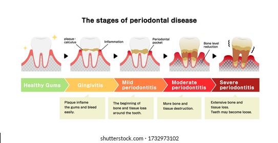 The stages of periodontitis disease vector illustration