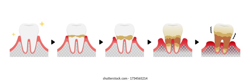 The stages of periodontitis disease vector illustration (no text)