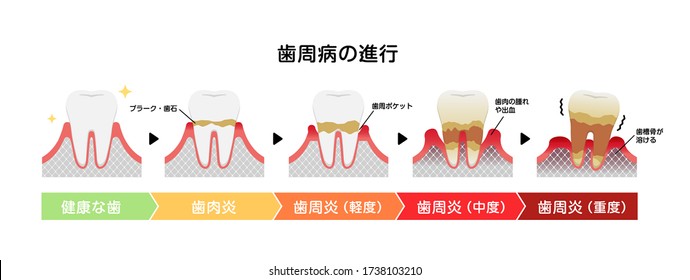The stages of periodontitis disease vector illustration. translation:  Plaque, Periodntal pocket, Inflammation, Bone level reduction, Normal gums, Gingivitis, Mild periodontitis, Moderate 