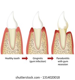 Stages of periodontitis medical vector illustration white background