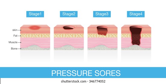 Stages of Pressure Sores of  patient skin which extends from skin into muscles and bone. This is medical illustration.