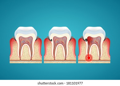 Stages progress caries on human teeth and disease gum, Toothache on blue background