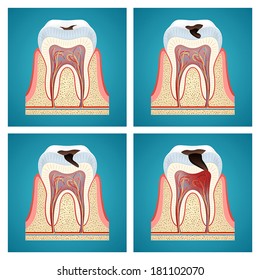 Stages Progress Dental Caries On Blue Background