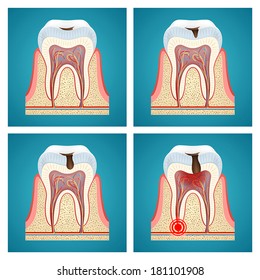 Stages Progress Dental Caries And Toothache