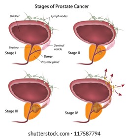 Stages Of Prostate Cancer