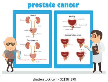 Stages Of Prostate Cancer And Cancer Consultation Man  Infographic.Vector Illustration