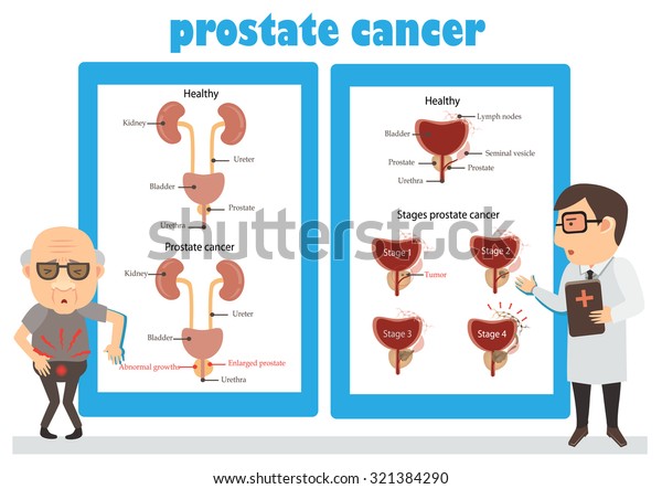 前立腺がんとがん相談マンインフォグラフィック ベクターイラスト のベクター画像素材 ロイヤリティフリー