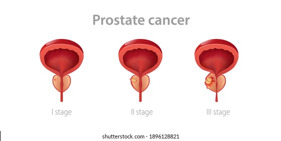 Stages Prostate Cancer. Disruption Of Male Gland With Its Growth Into Malignant Tumor Impaired Reproductive Function And Blockage Vector Urethra.