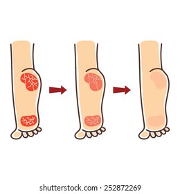 Stages of recovery of a crack on heels