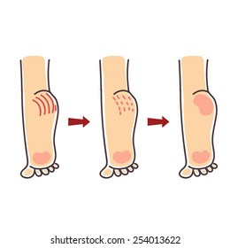 Stages of recovery of a wound on heels