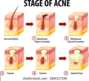 Stages Of Skin Acne Anatomy Illustration