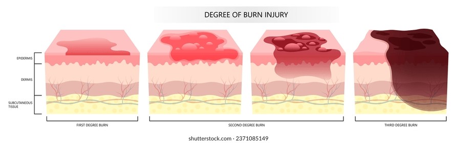 Stages of skin burn injury and scalds of epidermis and dermis layer cause by flames