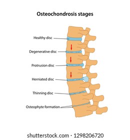 Stages of spinal osteochondrosis with main description: healthy disc, degenerative disc, protrusion, herniated, osteophyte formation. Vector illustration is isolated on white background