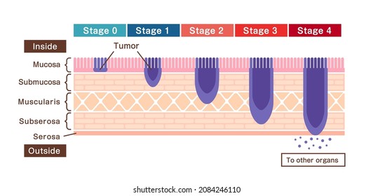 Stages of stomach cancer (gastric cancer) . Vector illustration