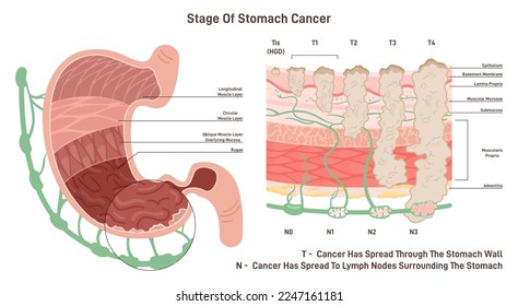 Stages of stomach cancer. Growth of pathological malignant cells or tumor in stomach wall tissue. Flat vector illustration