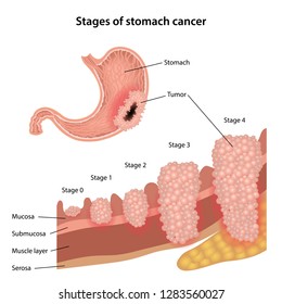 Stages of stomach cancer. Growth of cancer tumor growth. Anatomical vector illustration of the stomach with tumor and stages of stomach cancer isolated over white background. 