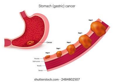 Stages of stomach cancer vector. Stages growth malignant cancerous tumor. Classification of Malignant tumours.