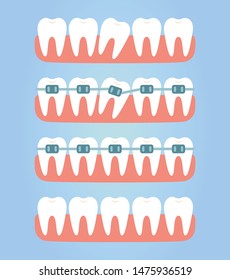 Stages of teeth alignment, before and after correction with brackets.Correction of teeth with orthodontic braces. Vector illustration in flat style