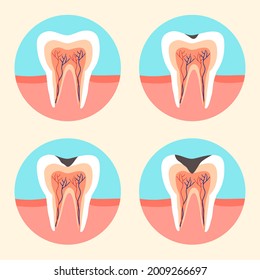 Etapas de caries dentales en diseño plano. Concepto de deterioro dental. Enfermedades dentales. 