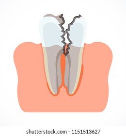 Stages of tooth decay with caries. Dentistry and oral care. Flat vector cartoon illustration. Objects isolated on white background.