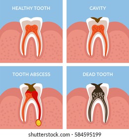 Stages Of Tooth Decay. Dental Anatomy Concept. Vector Illustration.