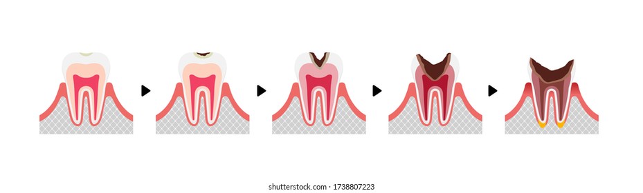 Die Stufen des Zahnabfalls / flache Vektorgrafik (kein Text) 