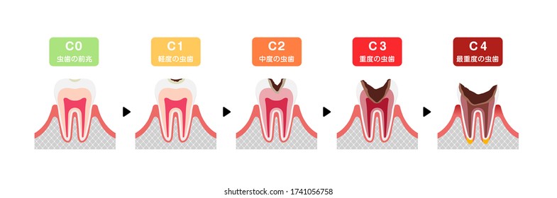 The stages of tooth decay flat vector illustration / translation: Mild, Moderate, Severe, Most severe.