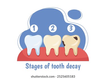 Phasen des Zahnverfalls. Medizinische Infografiken und Lehrmaterial. Sauberkeit und Hygiene. Diagnose und Behandlung. Flache Vektorgrafik einzeln auf weißem Hintergrund