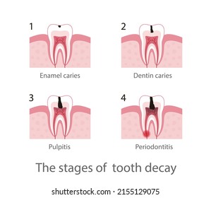 The stages of  tooth decay, vector illustration