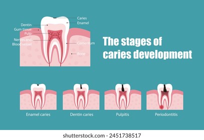 The stages of tooth decay, vector illustration