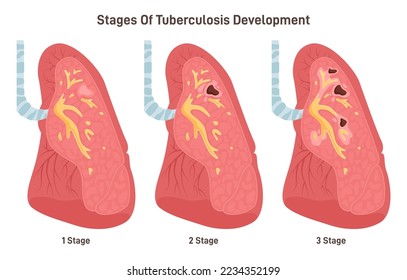 Stages of tuberculosis development. Respiratory system disease transmitted by airborne droplets. Human lung infected with mycobacterium tuberculosis. Flat vector illustration