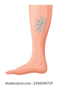 Etapas o tipos de desarrollo de venas varicosas. Afiche médico o infografía de enfermedad. Imagen de piernas enfermas. Ilustración vectorial en estilo plano