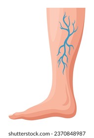 Stages or types of varicose veins development. Medical poster or disease infographic. Image of diseased legs. Vector illustration in flat style