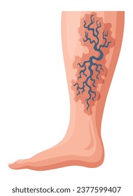 Stages or types of varicose veins development. Medical poster or disease infographic. Image of diseased legs. Vector illustration in flat style