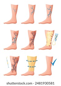 Etapas o tipos de desarrollo de las varices. Afiche médico o infografía de la enfermedad. Imagen de piernas sanas y enfermas. Ilustración vectorial en estilo plano