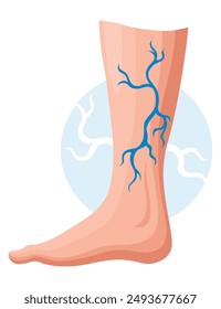 Etapas o tipos de desarrollo de las varices. Afiche médico o infografía de la enfermedad. Imagen de piernas enfermas. Ilustración vectorial en estilo plano