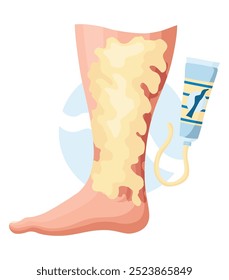 Etapas o tipos de desarrollo de las venas varicosas. Cartel médico o infografía de enfermedades. Imagen de piernas enfermas. Ilustración vectorial en estilo plano