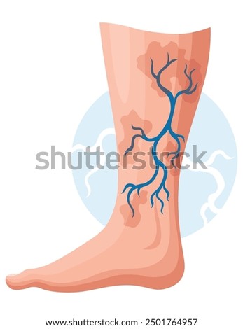 Stages or types of varicose veins development. Medical poster or disease infographic. Image of diseased legs. Vector illustration in flat style